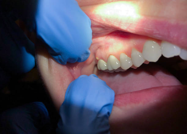 Best Emergency Tooth Extraction in Wildwood, MO